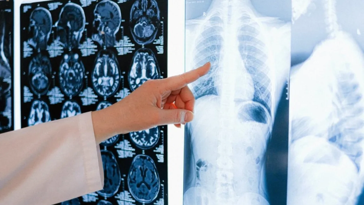 Imagen de una radiografía de pulmón.