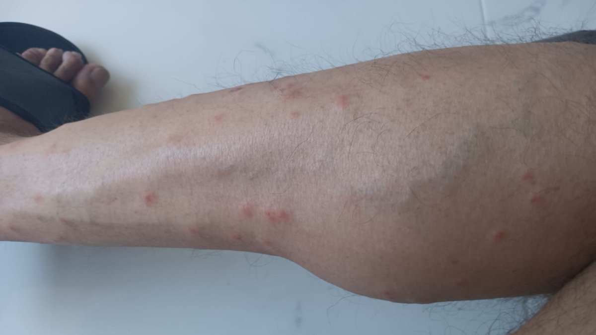 Imatge d’una cama amb diverses mossegades de mosca negra.