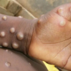 Imatge d'un nen afectat pel virus de la verola del mico.